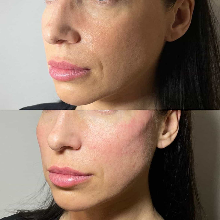 Non-Surgical Gaunt Face and Cheeks Treatment Options in the UK