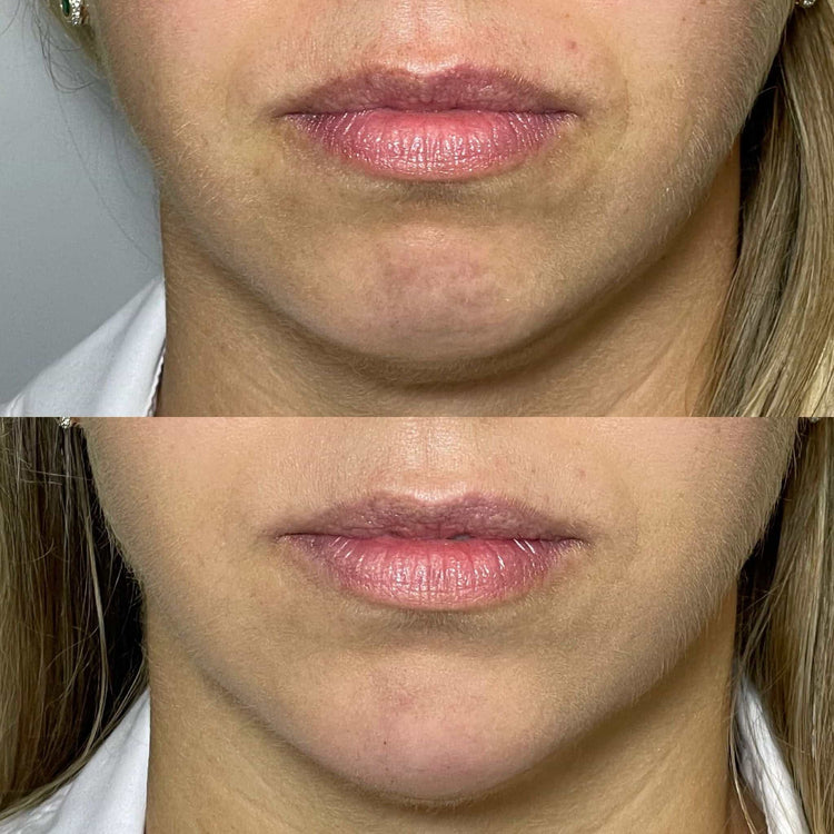 Non-Surgical Facelift in Fetcham, Surrey