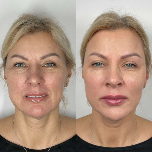 How Long Does Lip Filler Take To Dissolve