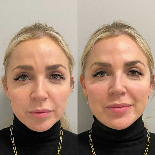 What is the best procedure for neck tightening?