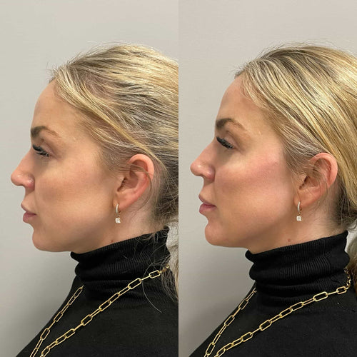How Long Does Lip Filler Take To Dissolve