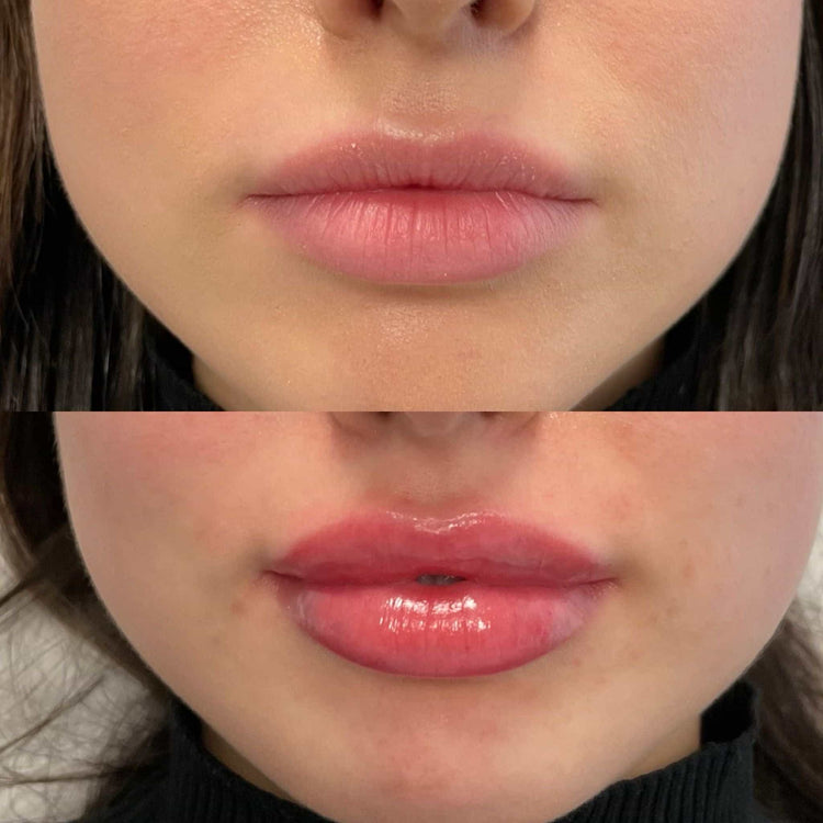Botox For Dark Circles in Staines-upon-Thames, Surrey