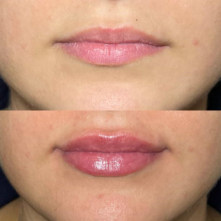 Dermal Fillers for Cheeks: Restoring Volume and Contours