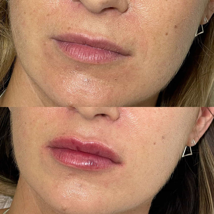 Skin Booster For Dark Circles in Oxshott, Surrey
