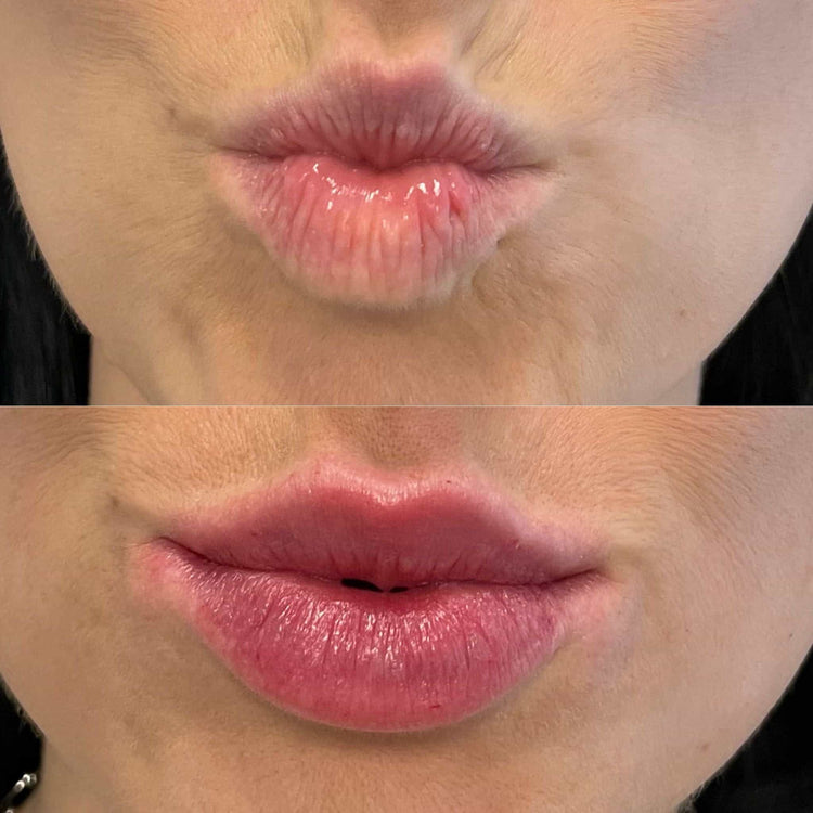 Skin Booster For Dark Circles in Oxshott, Surrey