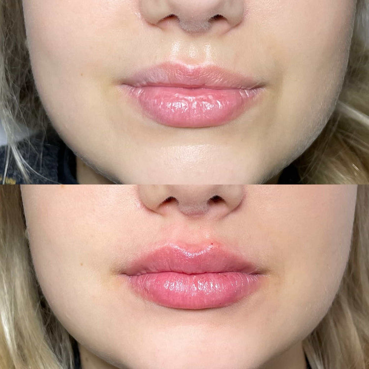 Skin Booster For Dark Circles in Oxshott, Surrey