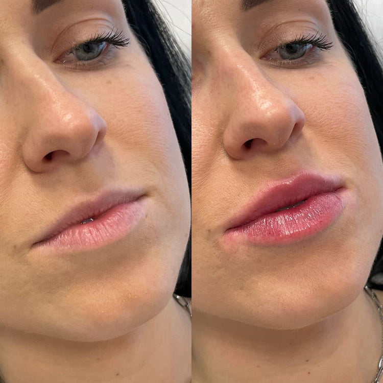 Midface Volume Restoration in Fetcham, Surrey