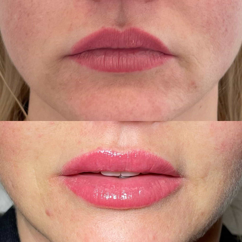 How Painful Are Cheek Fillers?