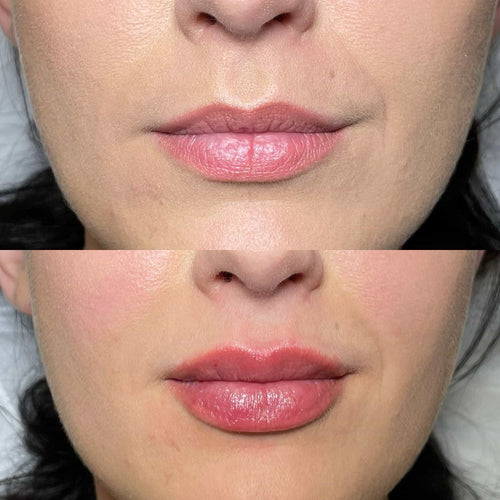 What is a lunchtime liquid facelift?