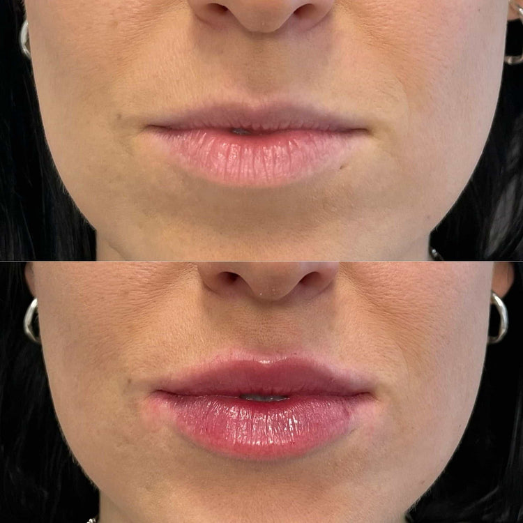 Midface Volume Restoration in Fetcham, Surrey