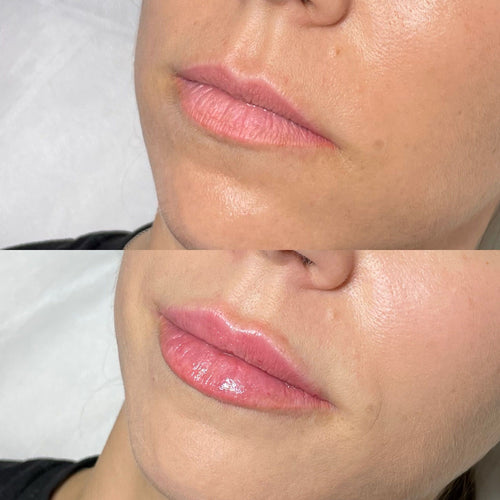 What If I Don't Like My Lip Fillers?