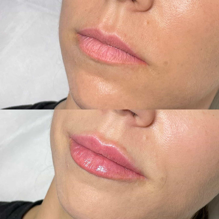 Midface Volume Restoration in Fetcham, Surrey