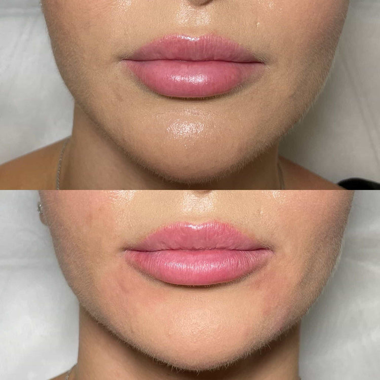 Botox Jaw Slimming (Masseter Reduction) in Barnes, London