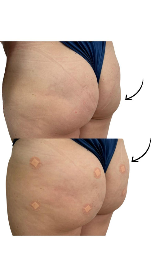 Preparation Tips for Your Bum Filler Injection Appointment