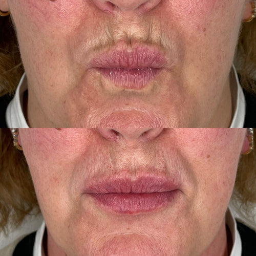 How Long To Wait For More Lip Filler