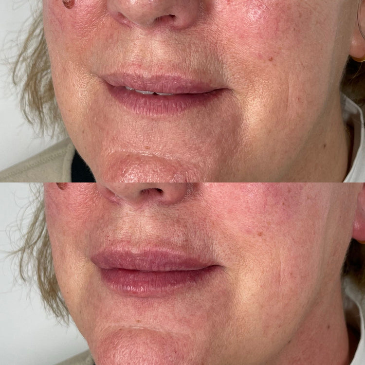 How to Spot Fake Dermal Fillers in the UK Market